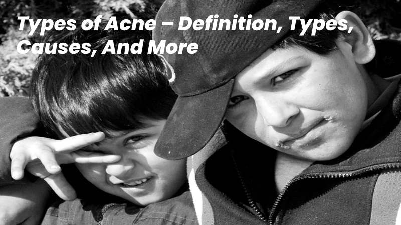 types of acne