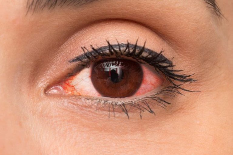 eye redness