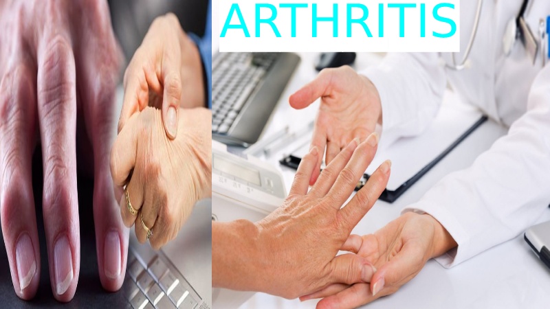 ARTHRITIS