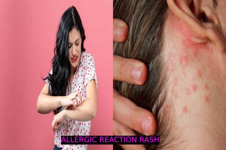 Allergic reaction rash