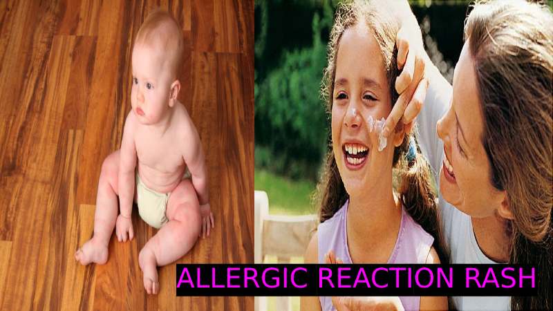 Allergic reaction rash