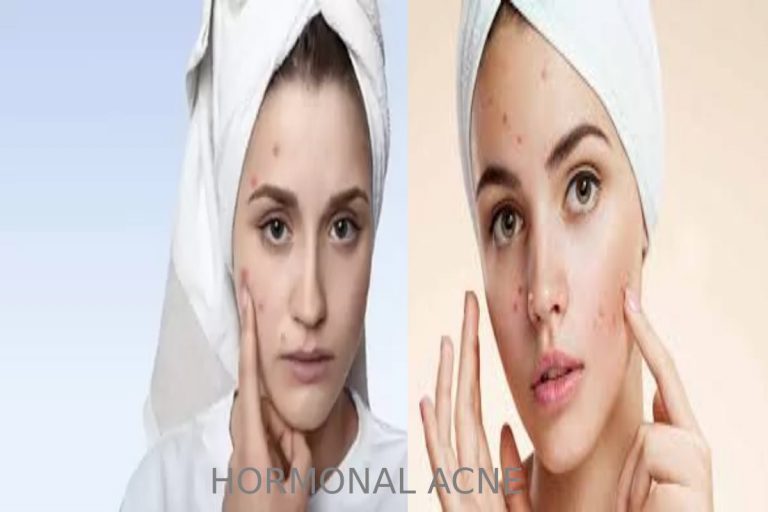 HORMONAL ACNE