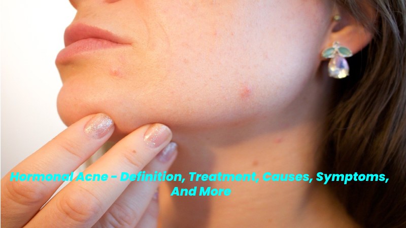 Hormonal Acne 