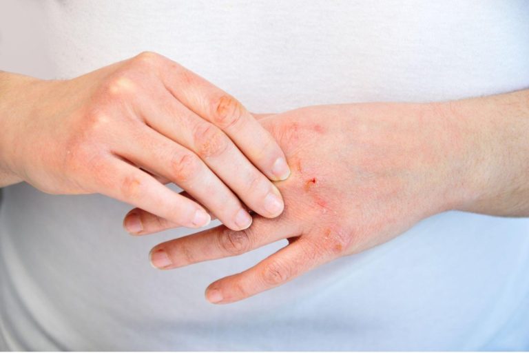 Dehydrated Hand