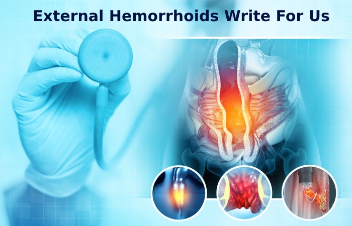 External Hemorrhoids Write For Us