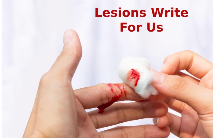 Lesions Write For Us