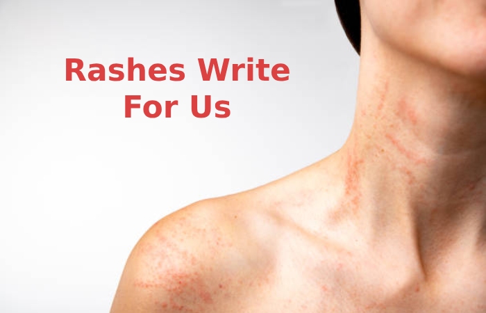 Rashes Write For Us