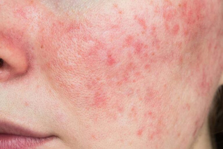 Rash on Face
