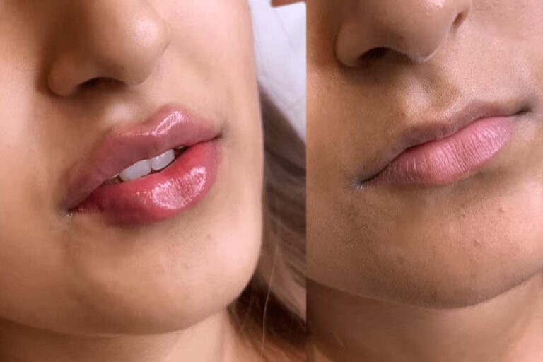 Juvederm Dermal Filler